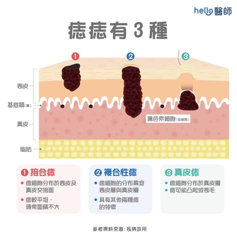 墨痣形成|墨形成：痣還是皮膚癌？